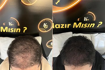 Saç Simülasyonu Nedir ve Nasıl Yapılır?