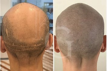 SMP ile Yara İzi Kamuflajı